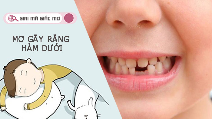 Mơ gãy răng hàm dưới là điềm báo gì - Đánh con gì thắng lớn?